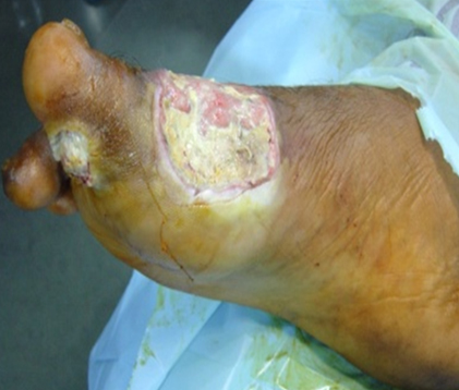 develop foot ulcer