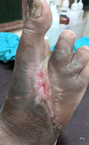 PAD & Toe gangrene