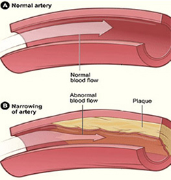 Peripheral Arterial Disease 