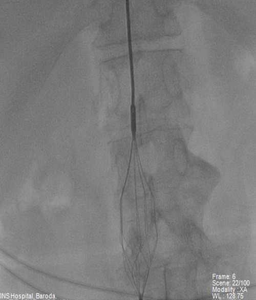  IVC Filter placement: