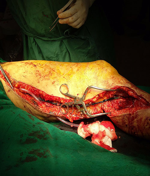 Vascular Bypass Surgery