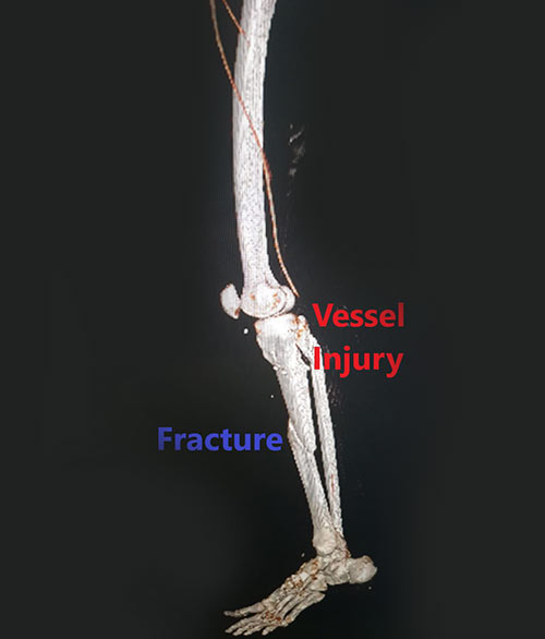 Vascular Injury