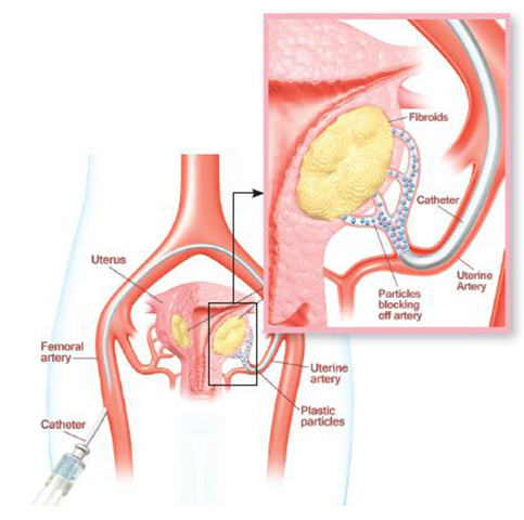 Uterine Artery Embolisation