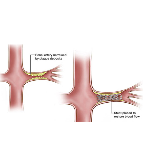 Renal Artery Stenosis Stenting