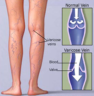 Vaginal varicose vein  best hospital for varicose veins treatment in  Ahmedabad, India 