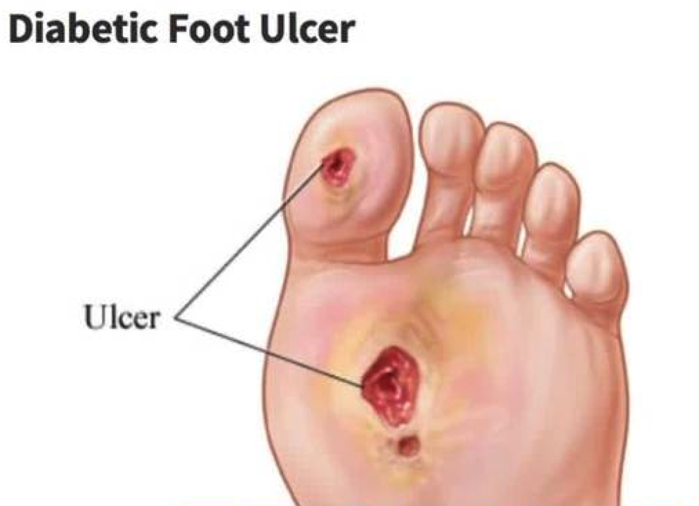 Diabetic Foot Ulcers Treatment 