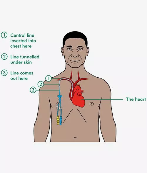 Hickman Line Hickman Line