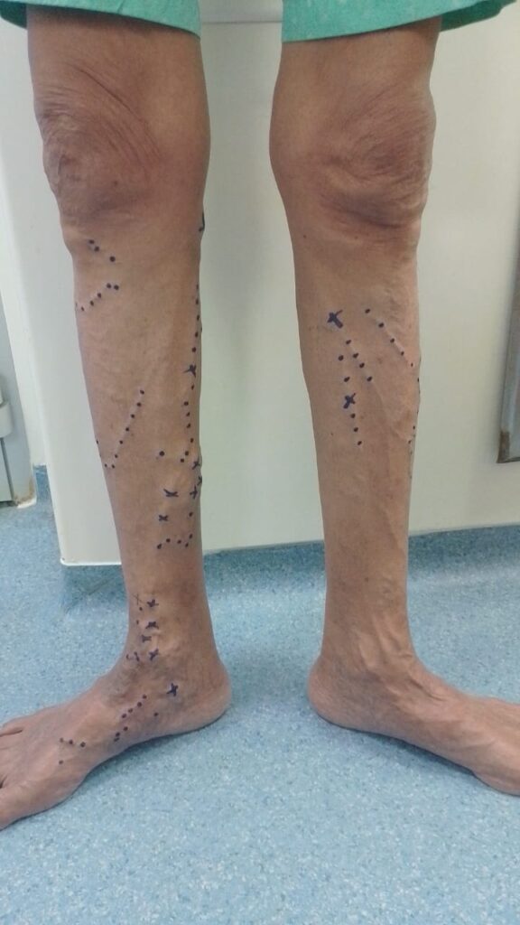 Varicose-Veins-Treatment-in-vadodara