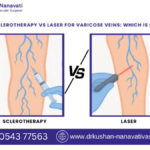 Sclerotherapy vs Laser for Varicose Veins
