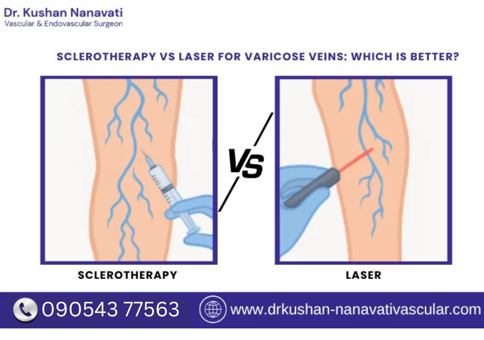 Sclerotherapy vs Laser for Varicose Veins
