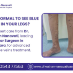 blue-veins-treatment-in-vadodara