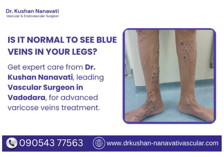 blue-veins-treatment-in-vadodara