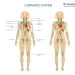 Diagram showing the human lymphatic system and lymph node locations for lymphedema treatment.