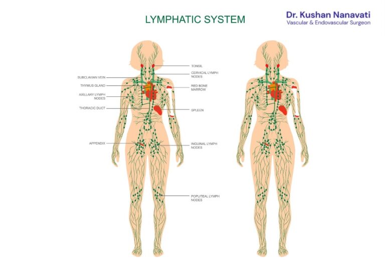 Diagram showing the human lymphatic system and lymph node locations for lymphedema treatment.