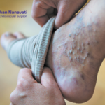 Varicose Veins Treatment in Vadodara