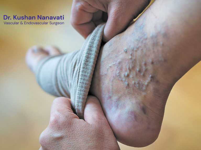 Varicose Veins Treatment in Vadodara
