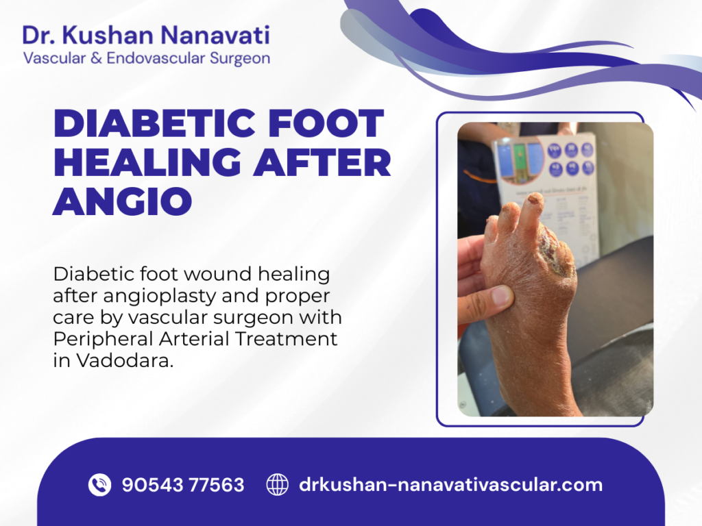 Peripheral Arterial Treatment in Vadodara by Dr. Kushan Nanavati