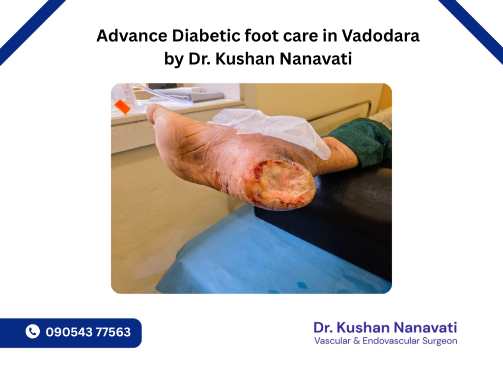 Diabetic foot treatment in Vadodara