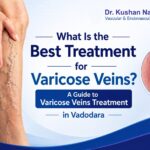 What Is the Best Treatment for Varicose Veins? A Guide to Varicose Veins Treatment in Vadodara