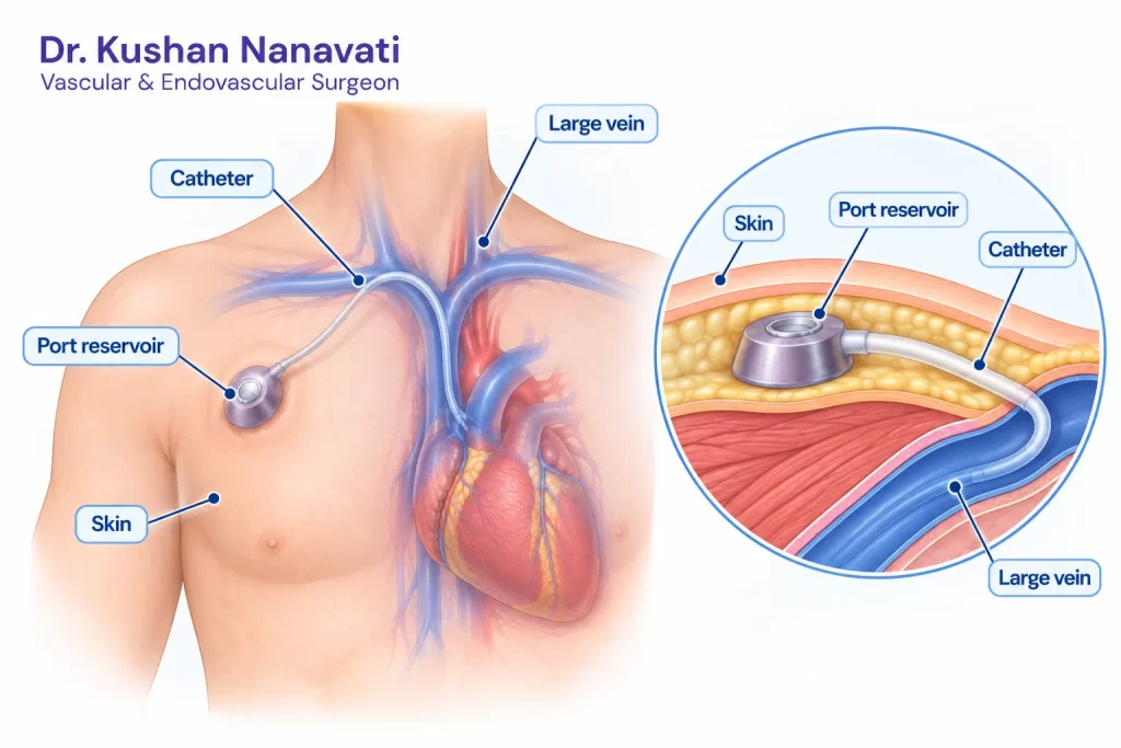 Chemoport anatomy showing port reservoir and catheter in a large vein