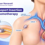 Chemoport insertion for chemotherapy showing implanted venous access port
