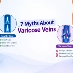 Varicose veins myths and facts explained by a vascular specialist