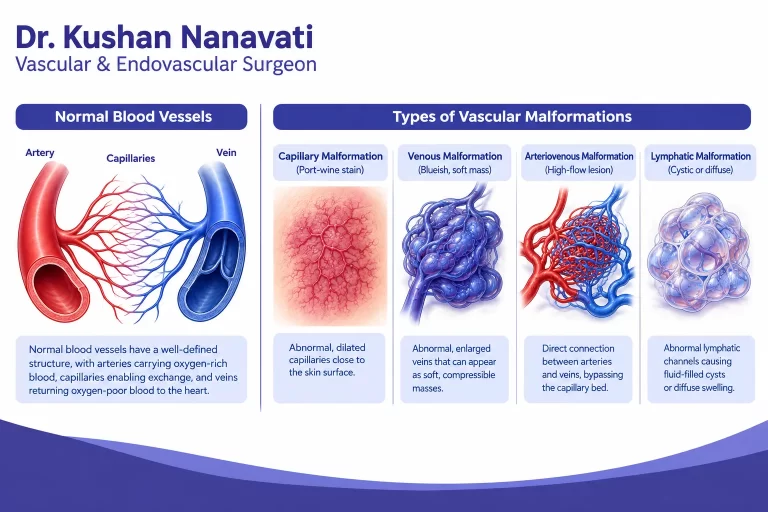 Vascular malformations explained with abnormal blood vessel illustration